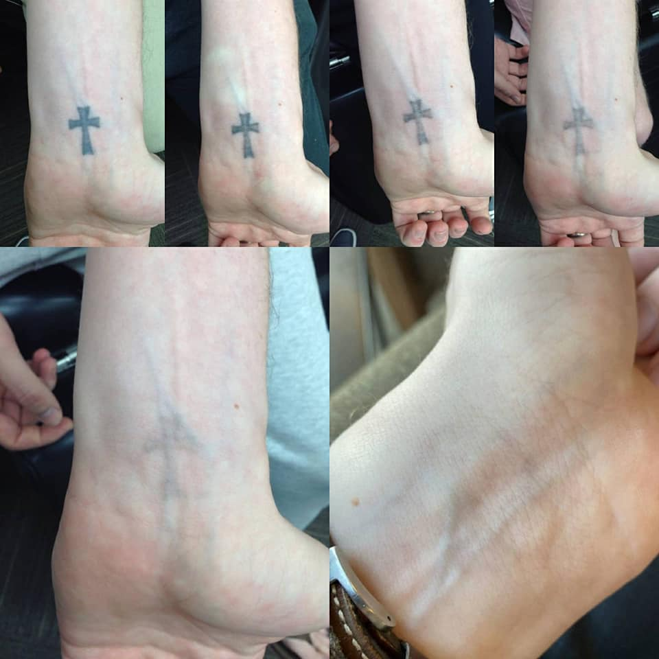 Before And After Tattoo Removal