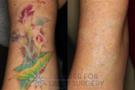 Expert Tattoo Removal Washington Dc Center For Laser Surgery Expert Tattoo Removal Washington Dc Center For Laser Surgery
