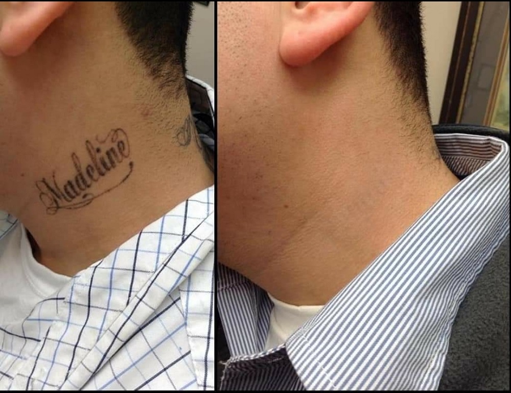 Laser Tattoo Before And After Laser Tattoo Before And After