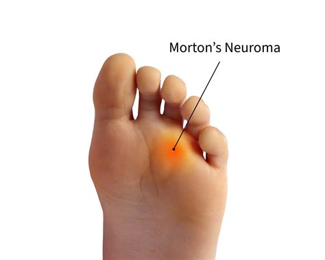 Morton S Neuroma Surgery In Miami Luxe Foot Surgery Morton S Neuroma Surgery In Miami Luxe Foot Surgery
