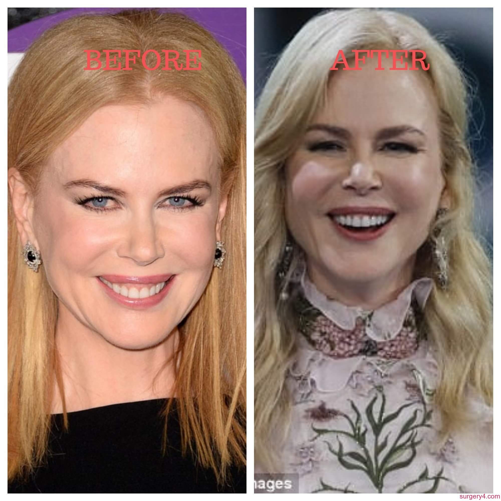 Nicole Kidman Plastic Surgery Photos Before Amp After Surgery4
