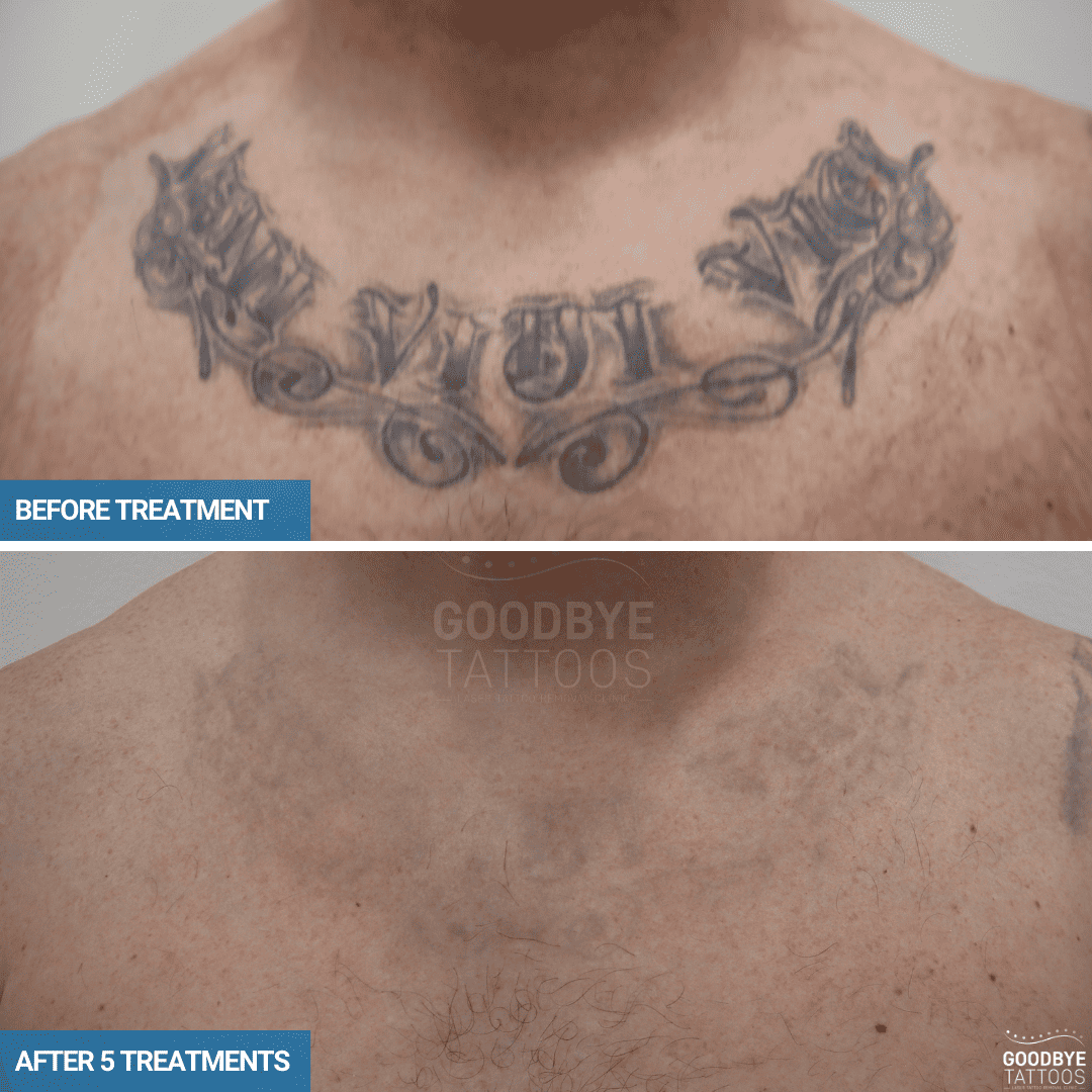 Tattoo Removal Before And After Goodbye Tattoos Sydney Tattoo Removal Before And After Goodbye Tattoos Sydney